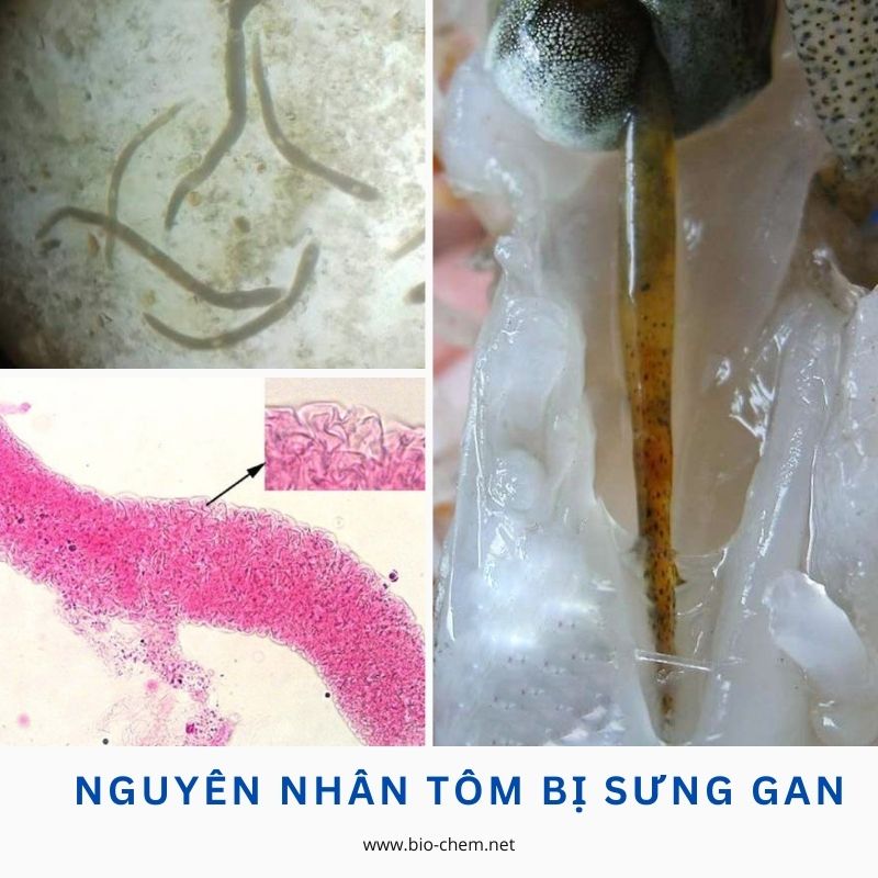 Nguyen nhan tom bi sung gan